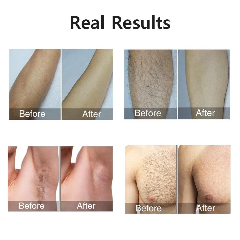 Máquina de depilación IPL profesional